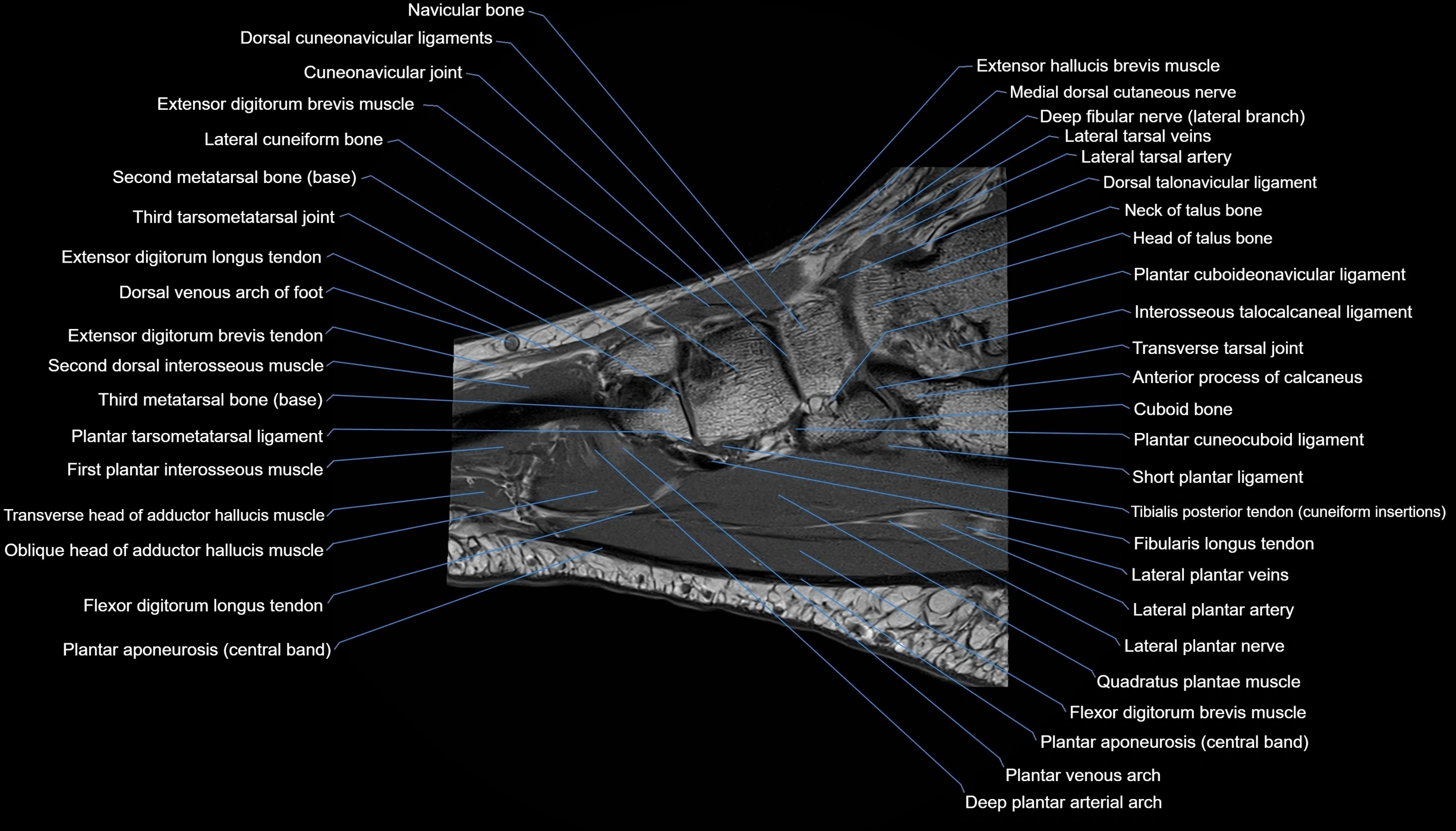 MRI mid foot sagittal cross sectional anatomy 3T  radiology  image-img-00001-00021.webp